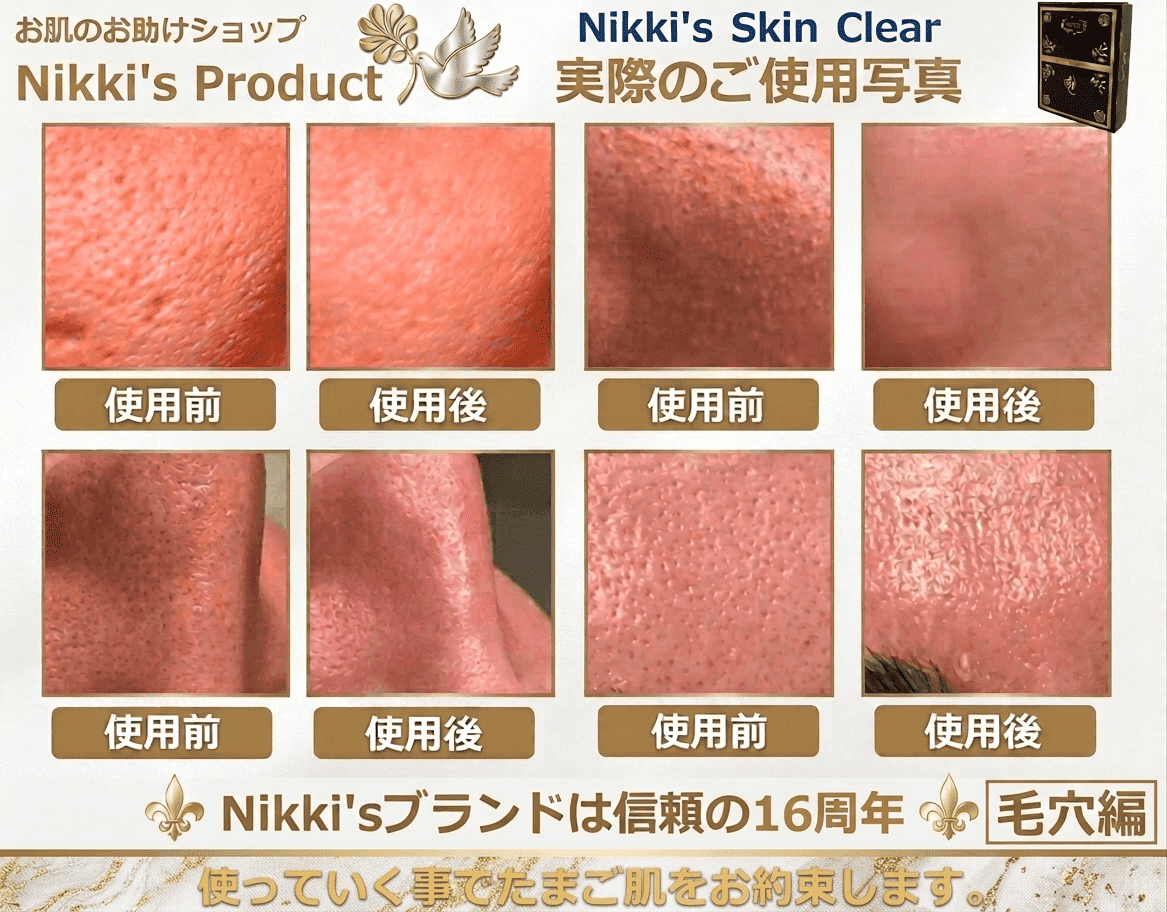 ニッキーズスキンクリア　通常使用３本　石鹸　未使用品 ニッキーズスキンクリア Nikki's Skin Clear 通常使用 (シミ、そばかす