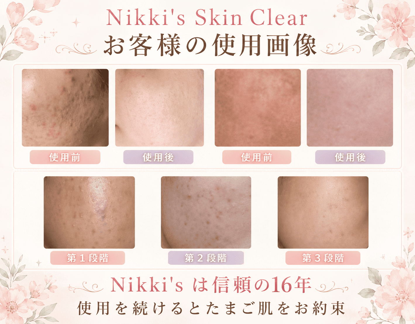 しみ、そばかす、ニキビ跡、毛穴　噂のNikki's Skin Clear　通常版 ニッキーズスキンクリア Nikki's Skin Clear 通常使用 (シミ、そばかす